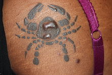 Tattoo_keloid